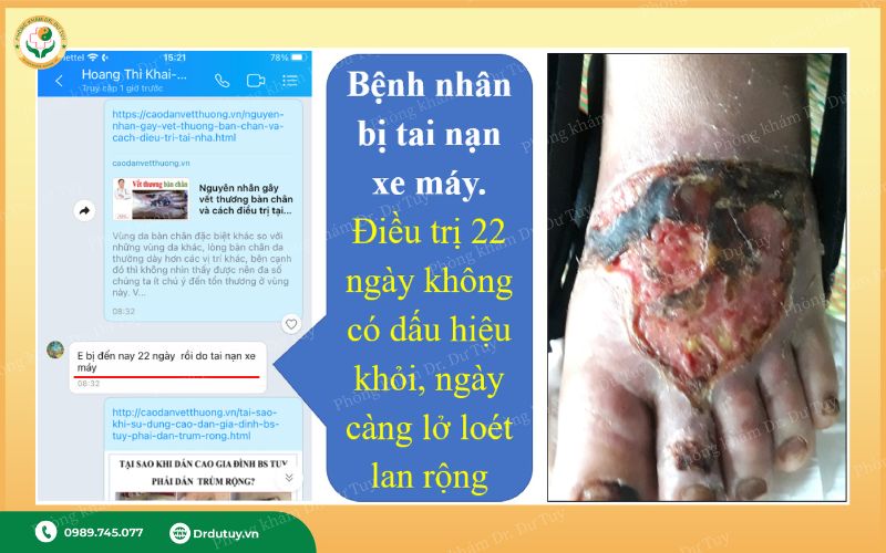 điều trị vết loét bàn chân