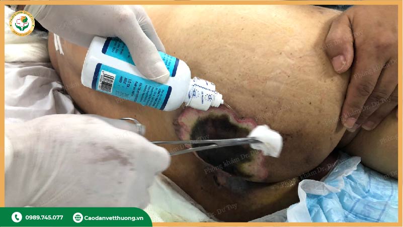 điều trị vết loét da