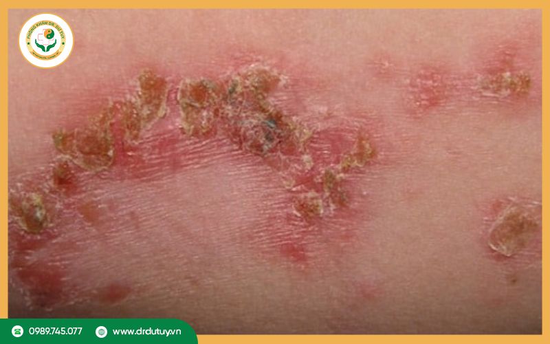 Điều trị vết loét lâu lành tại nhà bằng cao dán Dr Dư Tuy
