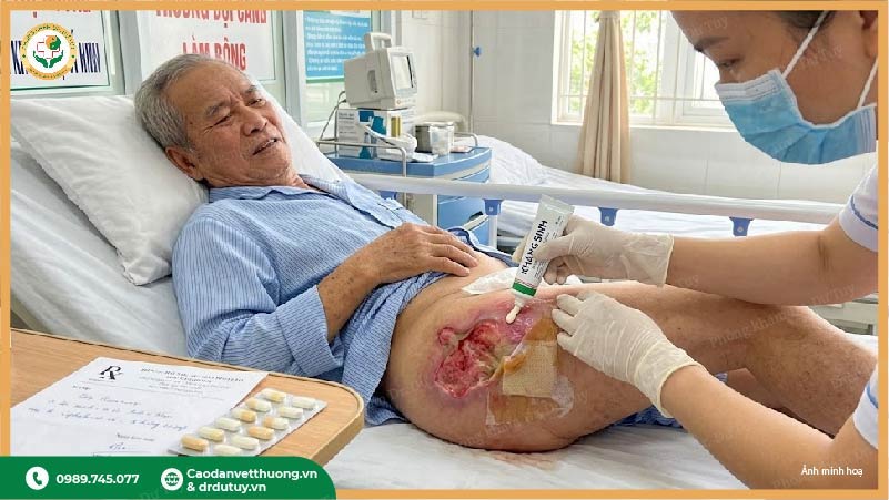 điều trị vết loét sau tai biến
