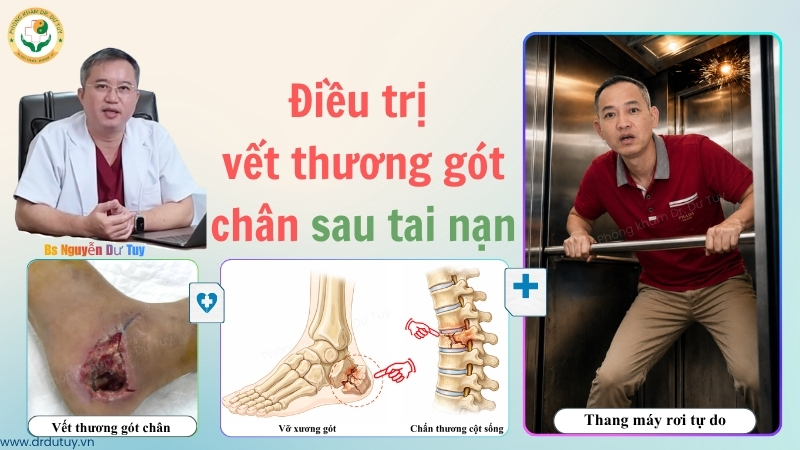 điều trị vết thương gót chân sau tai nạn Dr. Dư Tuy