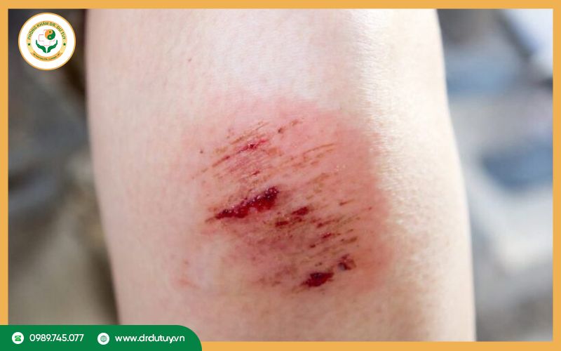 Làm sao để vết thương hở nhanh lành không để lại sẹo