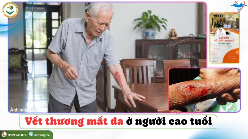 điều trị vết thương mất da ở người cao tuổi