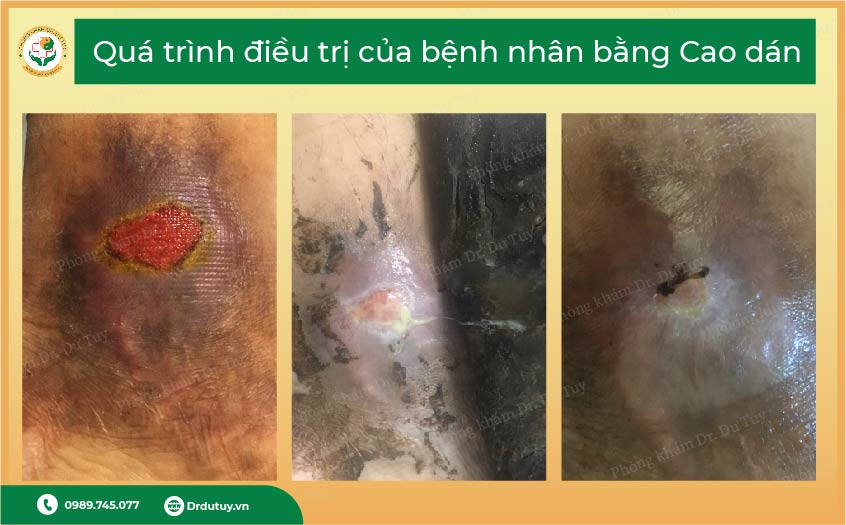 điều trị vết thương nhẹ