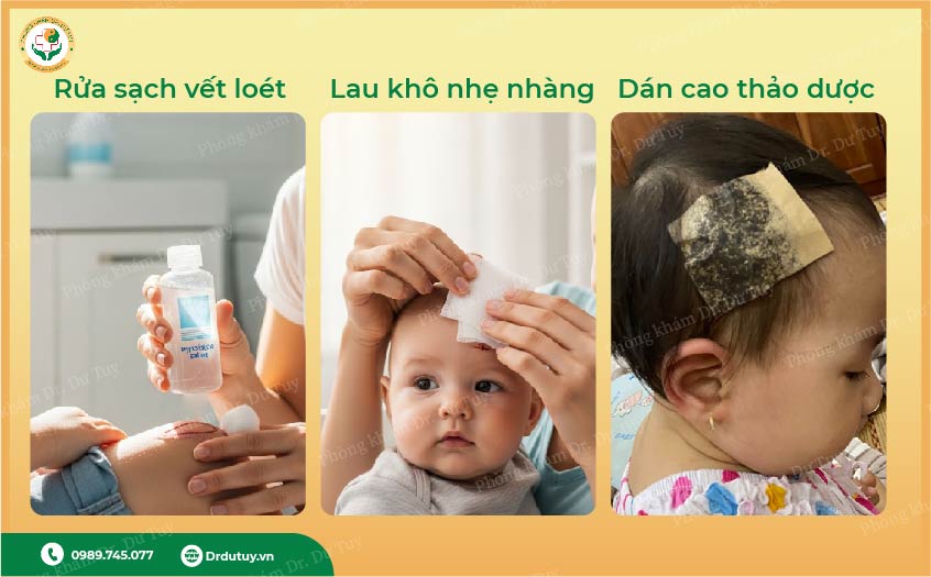 điều trị viêm da trẻ em