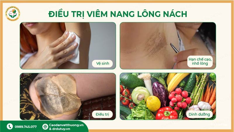điều trị viêm nang lông nách