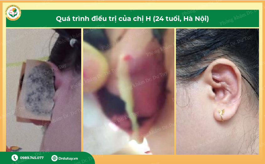 điều trị viêm sụn vành tai tại nhà
