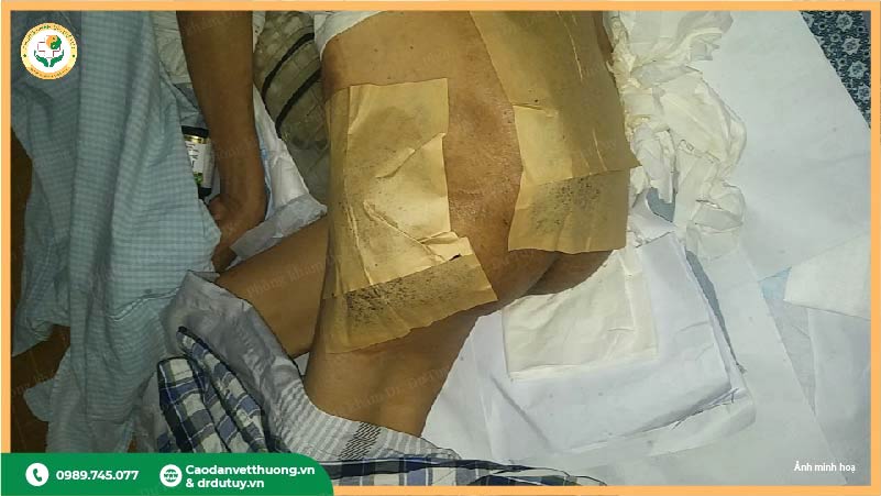 đối tượng sử dụng miếng dán vết thương