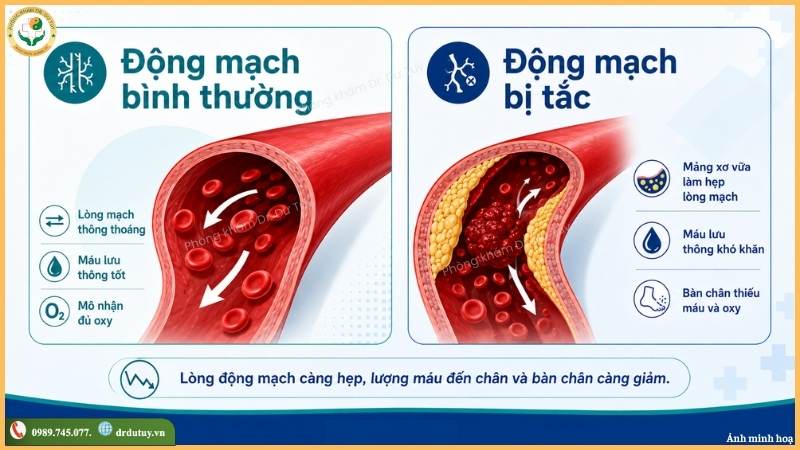 động mạch bình thường và động mạch bị tắc