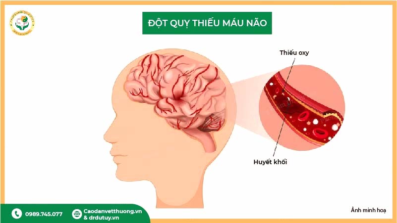 đột quỵ thiếu máu não là gì?
