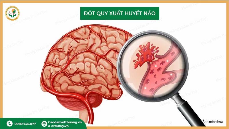 đột quỵ xuất huyết não