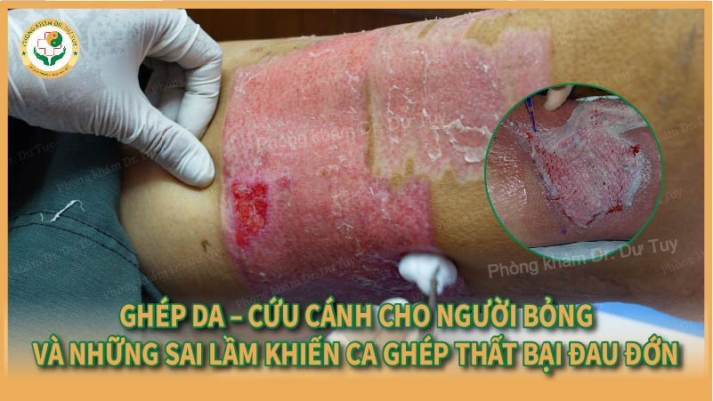 Ghép da – Cứu cánh cho người bỏng và những sai lầm khiến ca ghép thất bại đau đớn