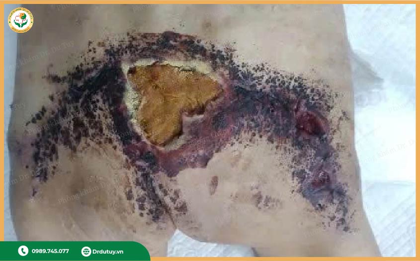 ghép da ở người già yếu