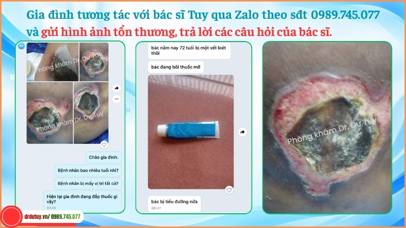 gia đình trao đổi bác sĩ vết loét cùng cụt