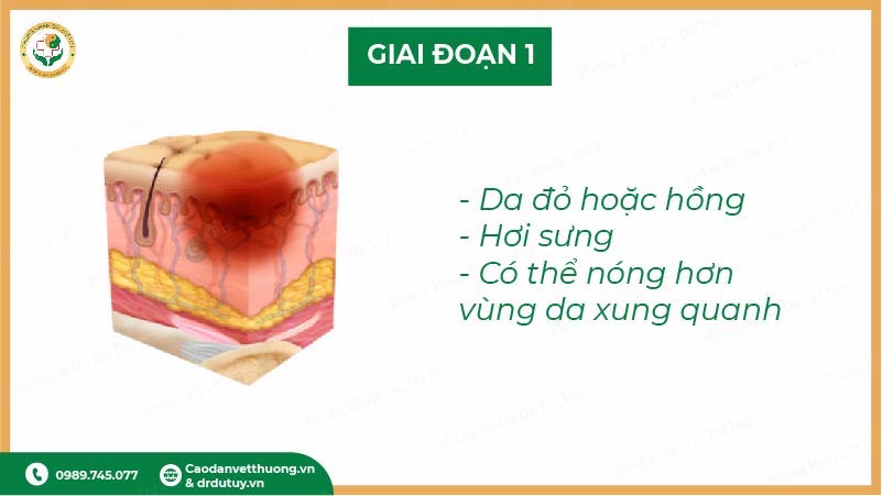 giai đoạn 1 vết loét tỳ đè