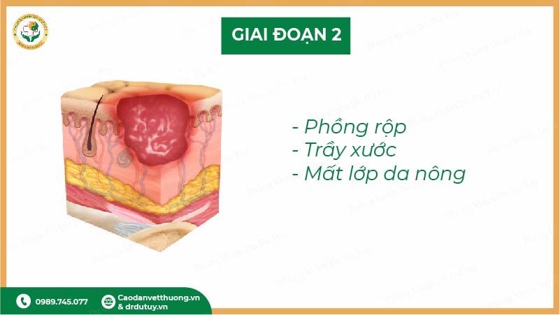 giai đoạn 2 vết loét tỳ đè