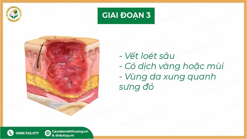 giai đoạn 3 vết loét tỳ đè