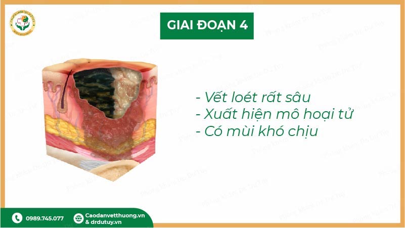 giai đoạn 4 vết loét tỳ đè