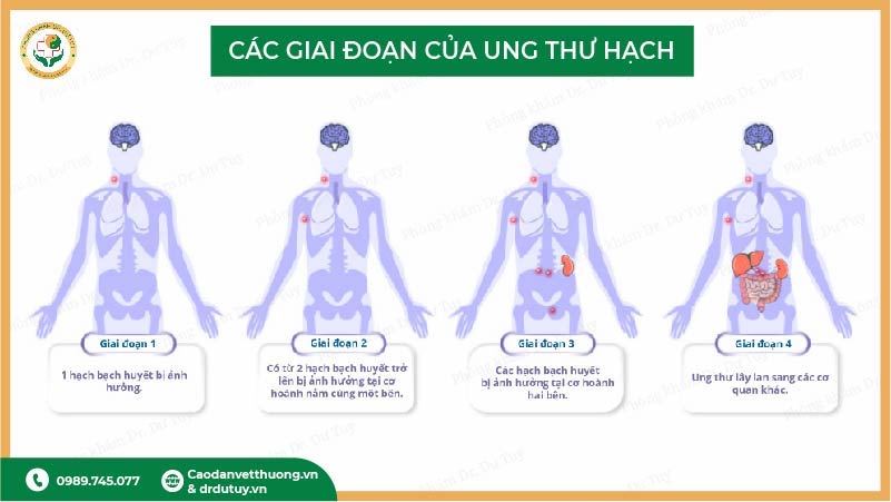 giai đoạn ung thư hạch 1,2,3,4