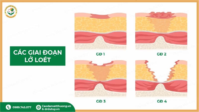 giai đoạn vết loét tỳ đè