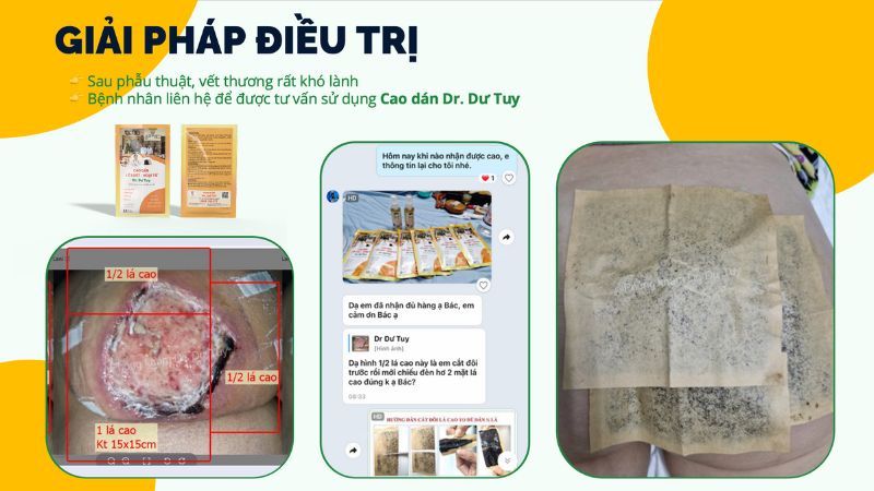 giải pháp điều trị biến chứng filler