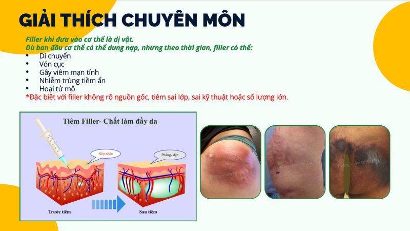 giải thích chuyên môn filler là dị vật