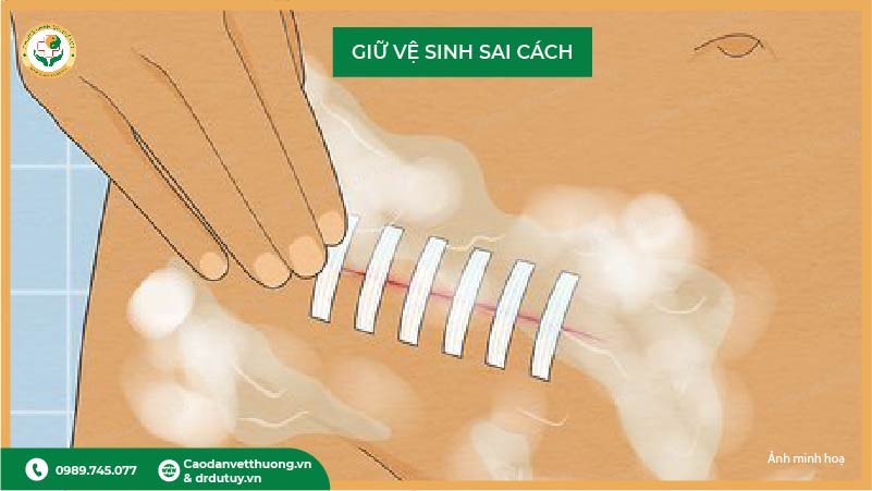 giữ vệ sinh vết mổ sai cách khiến vết thương chậm lành