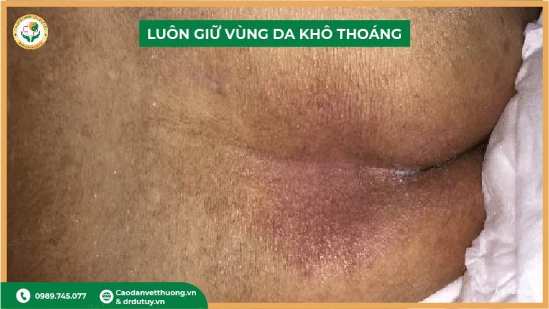giữ vùng da cùng cụt khô thoáng