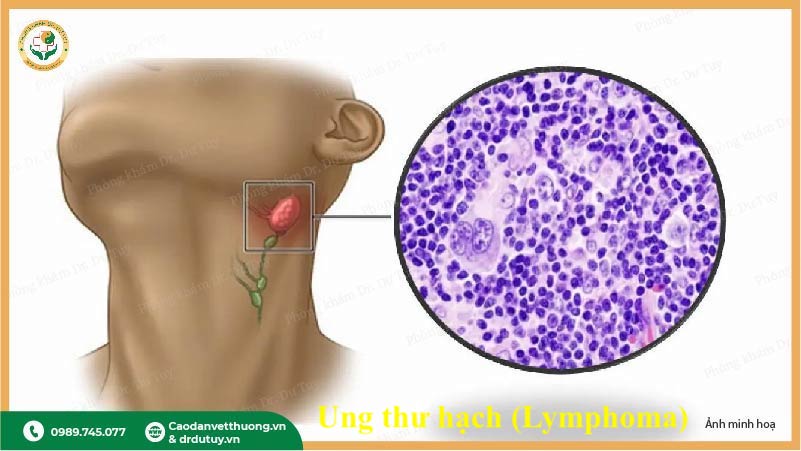 hạch bạch huyết tế bào lumpho ung thư hạch