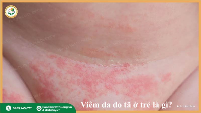 hăm tã vùng bẹn do kích ứng ở trẻ