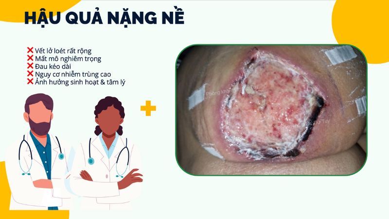 hậu quả nặng nề hoại tử sau tiêm filler