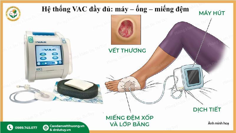 hệ thống máy VAC điều trị vết thương