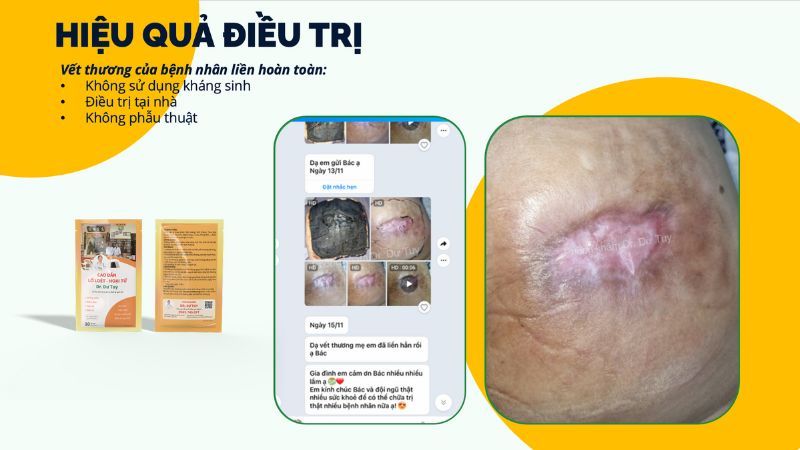 hiệu quả điều trị biến chứng filler
