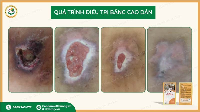 hiệu qủa miếng dán vết thương thực tế