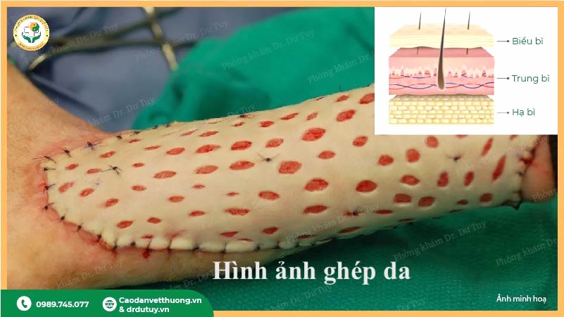 hình ảnh ghép da mesh graft điều trị hoại tử