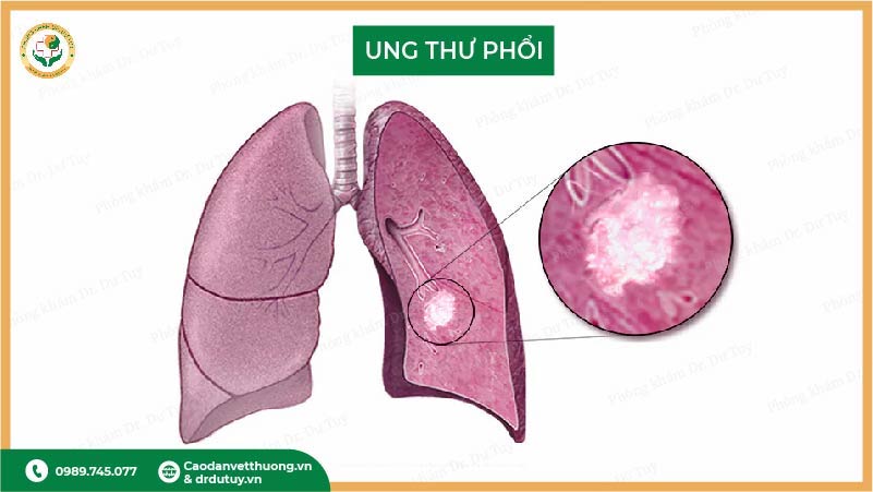 hình ảnh khối u ung thư phổi