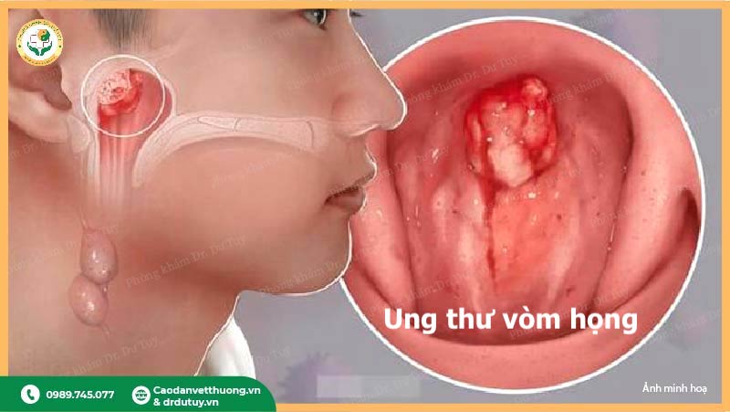 hình ảnh khối u ung thư vòm họng