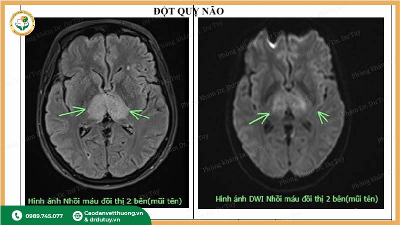hình ảnh nhồi máu não trên MRI