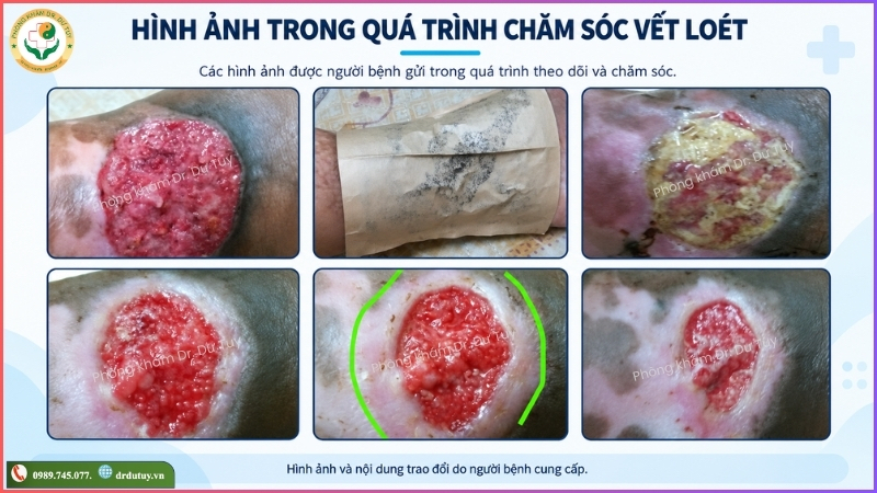 hình ảnh quá trình chăm sóc vết loét