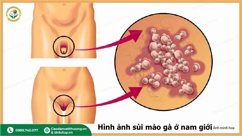 hình ảnh sùi mào gà ở vùng kín