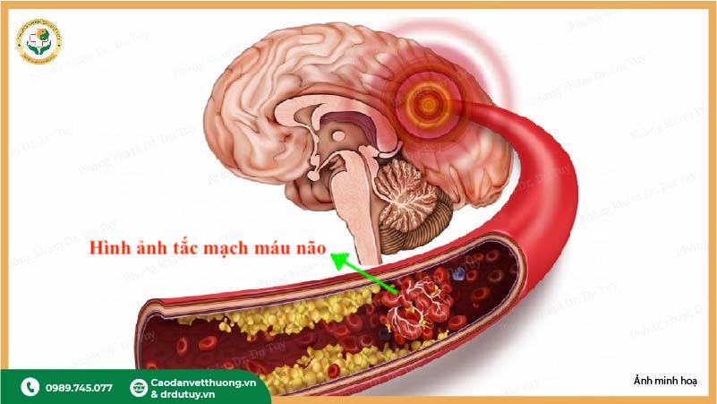 hình ảnh tắc mạch máu não