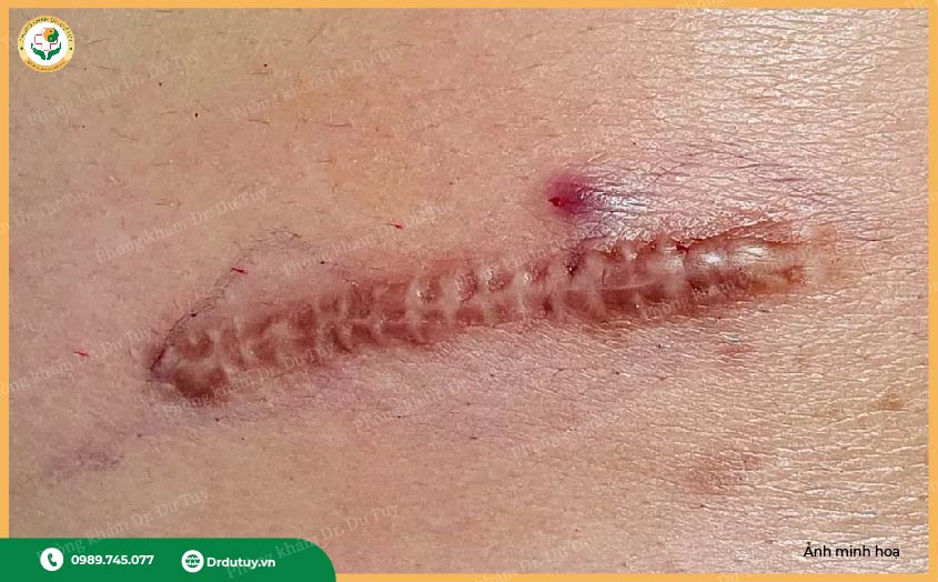 hình ảnh vết mổ nhiễm trùng