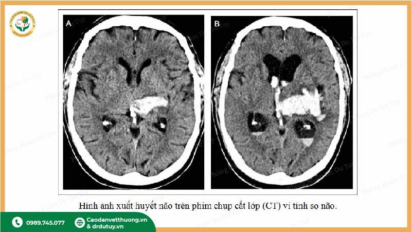 hình ảnh xuất huyết não trên CT