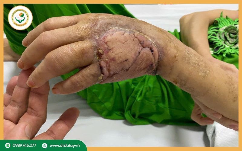 Hoại tử bàn tay là gì? Nguyên nhân, dấu hiệu và cách điều trị
