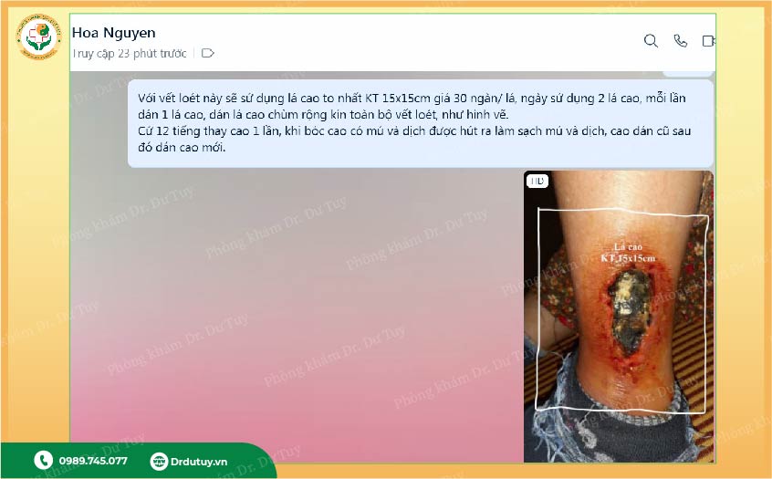 hoại tử chân do tiểu đường