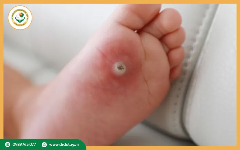 Hoại tử da có chữa được không? Hướng điều trị an toàn hiện nay