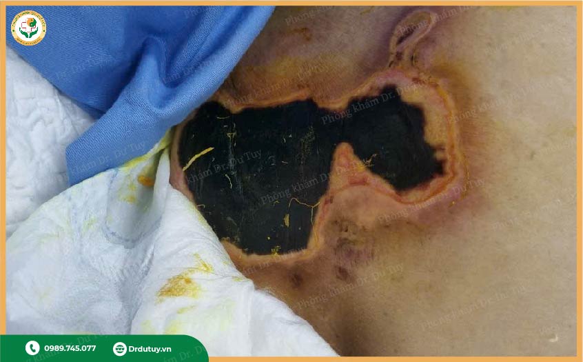 hoại tử da có lây không?