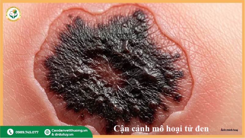 hoại tử da đen dấu hiệu nguy hiểm