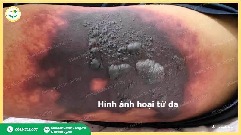 hoại tử da vùng mông mức độ nặng