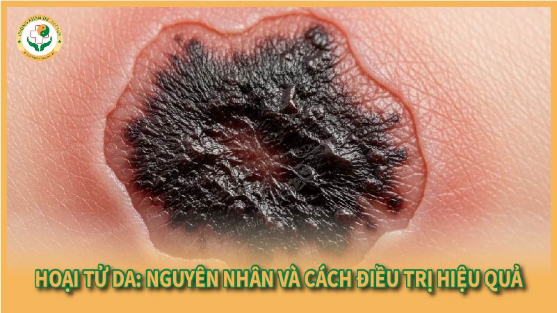 Hoại tử da: Nguyên nhân và cách chăm sóc phù hợp